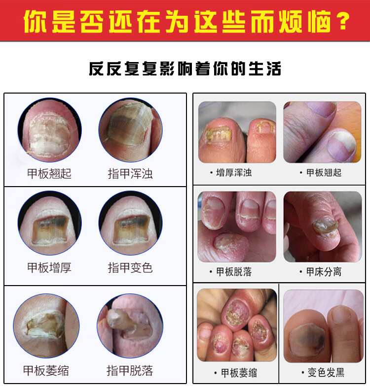 灰指甲灰甲净亮甲脱甲膏液甲沟炎专用灰指甲新亮甲1盒升级装