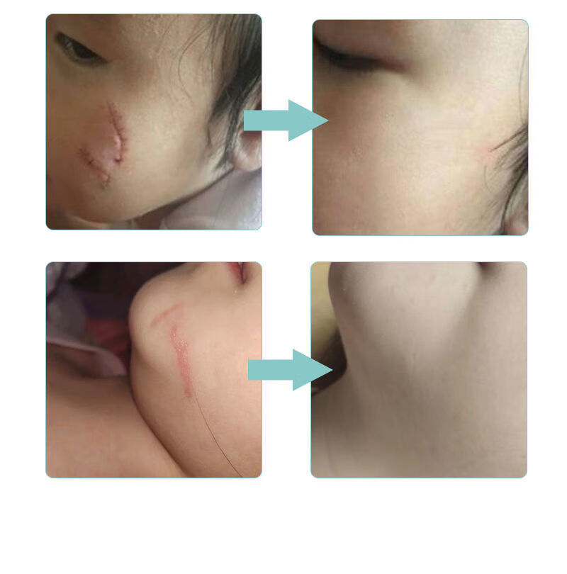 膏儿童小孩学生抓摔伤宝宝脸部手术缝针凹凸无痕去疤痕修复膏 1支体验