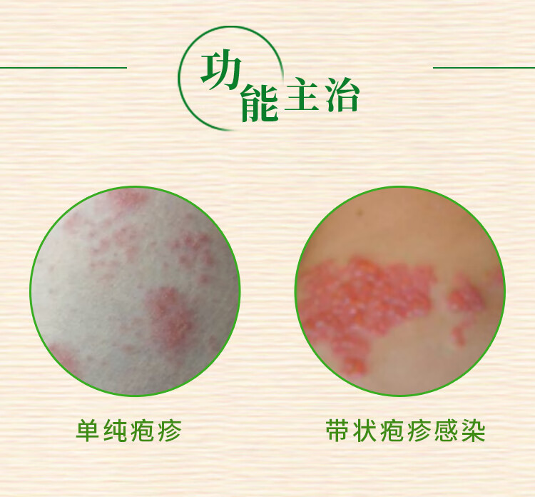 羚锐阿昔洛韦乳膏20g疱疹病毒膏单纯疱疹带状疱疹湿疹止痒药膏 3支