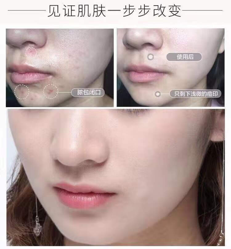 【官方旗舰】痘印膏 痘坑微商同款日期新鲜货源保证 胡培芝祛痘膏