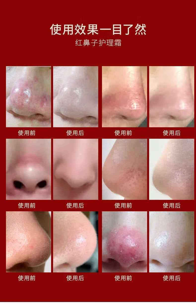 官方旗舰酒糟鼻草莓鼻红鼻子软膏去黑头粉刺除螨虫红血丝鼻子鼻头男女