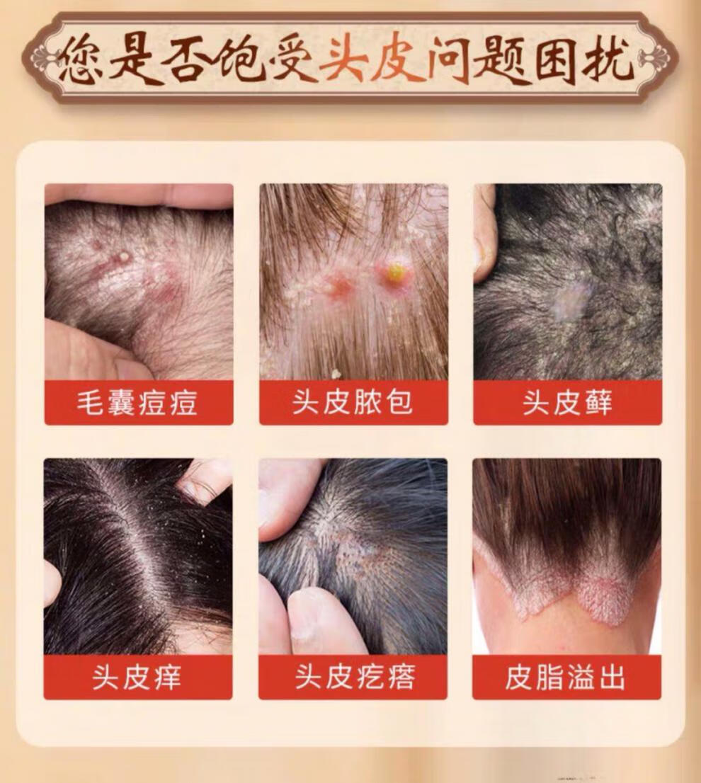 马拉色菌洗发水白云山毛囊焱炎控油洗发水去屑脓包螨虫疙瘩止痒露 一