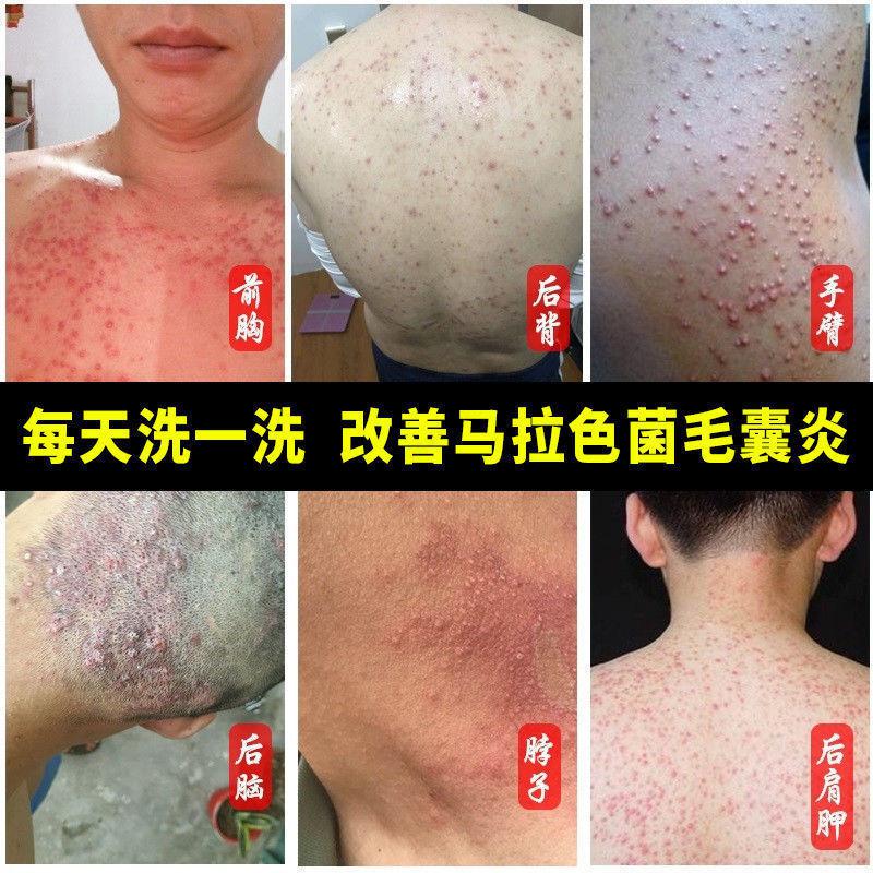 马拉色菌毛囊焱炎沐浴露除螨油性皮肤后背胸前手臂疙瘩痘 6瓶【图片