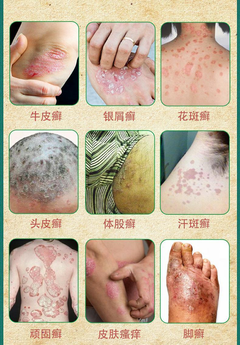 复方黄柏癣祛搽剂初肤堂同款癖祛喷剂牛皮鲜癣屑银病组合套装 买1