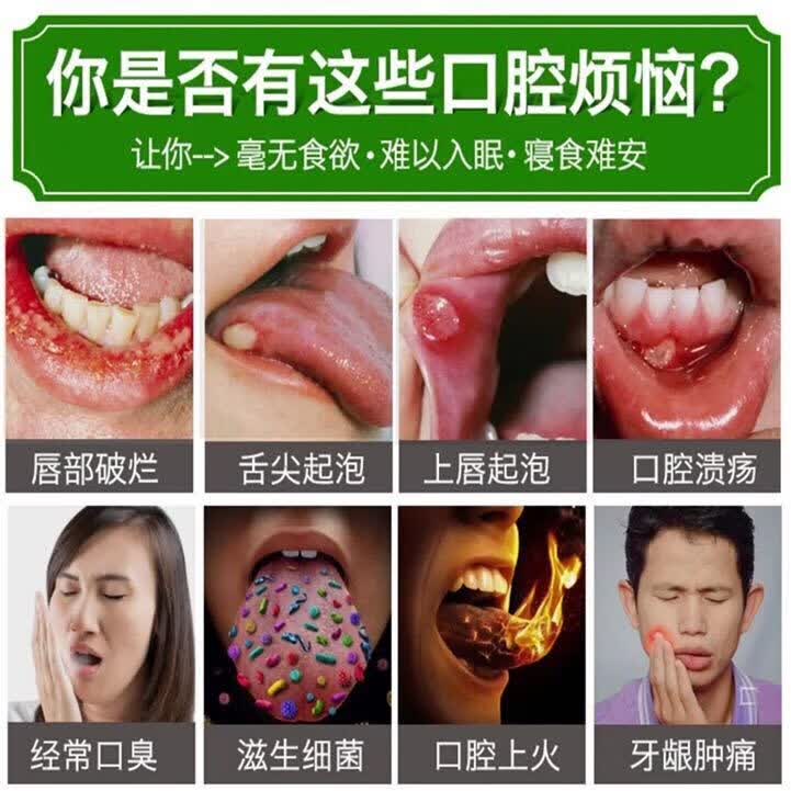 广雅口腔溃疡液喷剂口腔喷雾溃烂嘴上火舌头起泡牙痛宁口腔溃疡牙痛宁