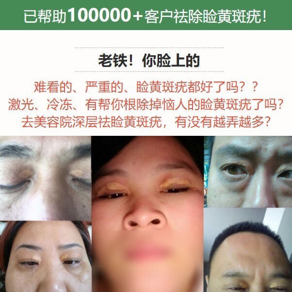 官方旗舰除睑黄疣圆眼部睑黄瘤膏睑黄瘤睑黄疣膏眼瘤脂肪粒汗管疣眼部
