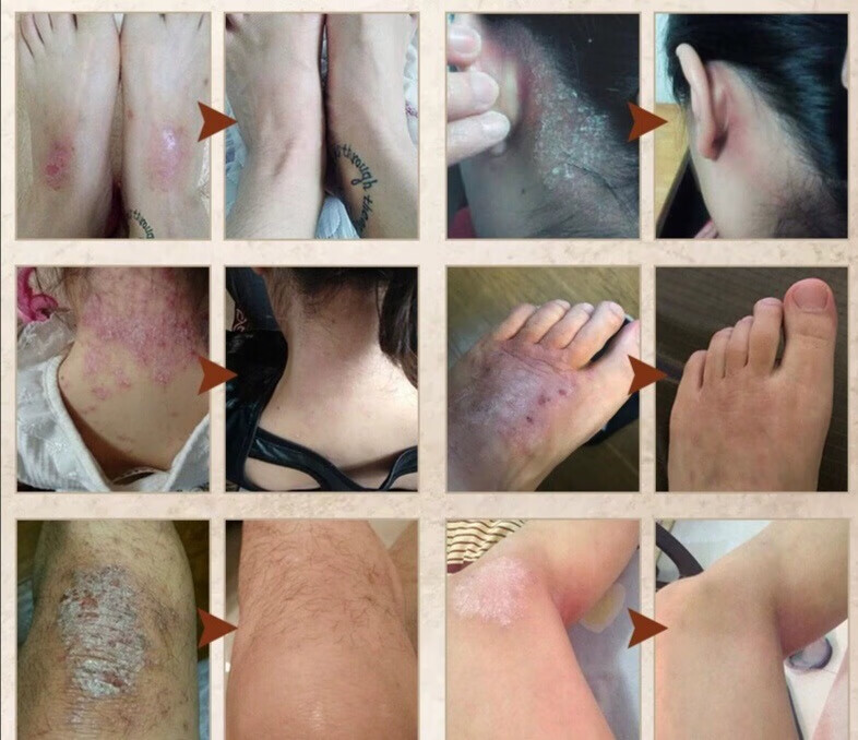 【官方旗舰】阴囊瘙痒慷安立青健百医青奇草1膏紫椒癣青酊紫青花膏