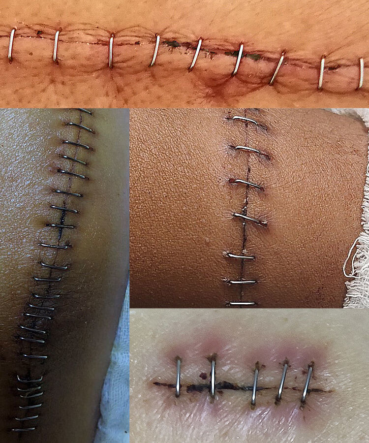 开颅等缝合针外科手术后伤口拆钉器专用皮肤取钉器医用起钉器割包皮术