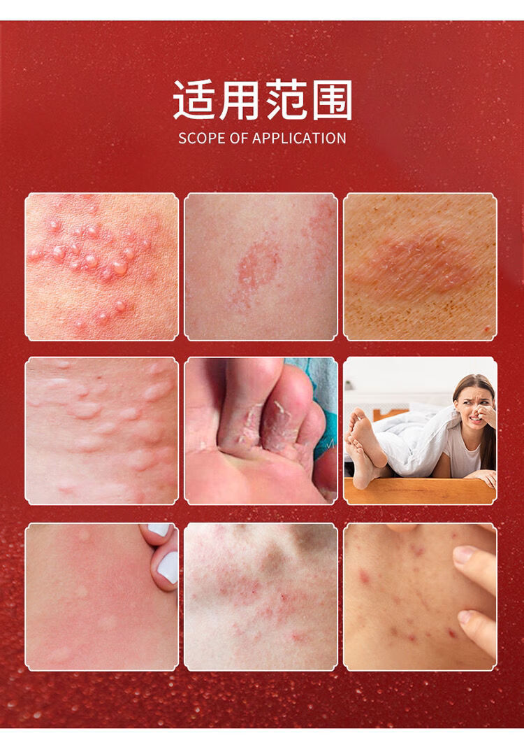 笔尖器械保健药房直售画皮软膏皮肤外阴湿痒肛门阴囊瘙痒脱皮水泡脚足