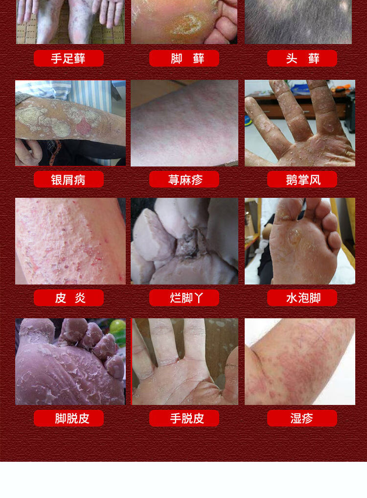 止痒膏云南青草膏成人儿童快速止痒膏过敏身上痒皮ii炎湿ii疹荨麻ii疹