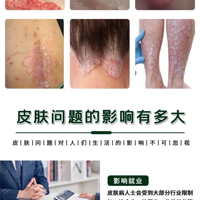 邹润安百草止痒膏神农百草奇白消皮肤瘙痒皮肤外用草本乳膏 3瓶周期装