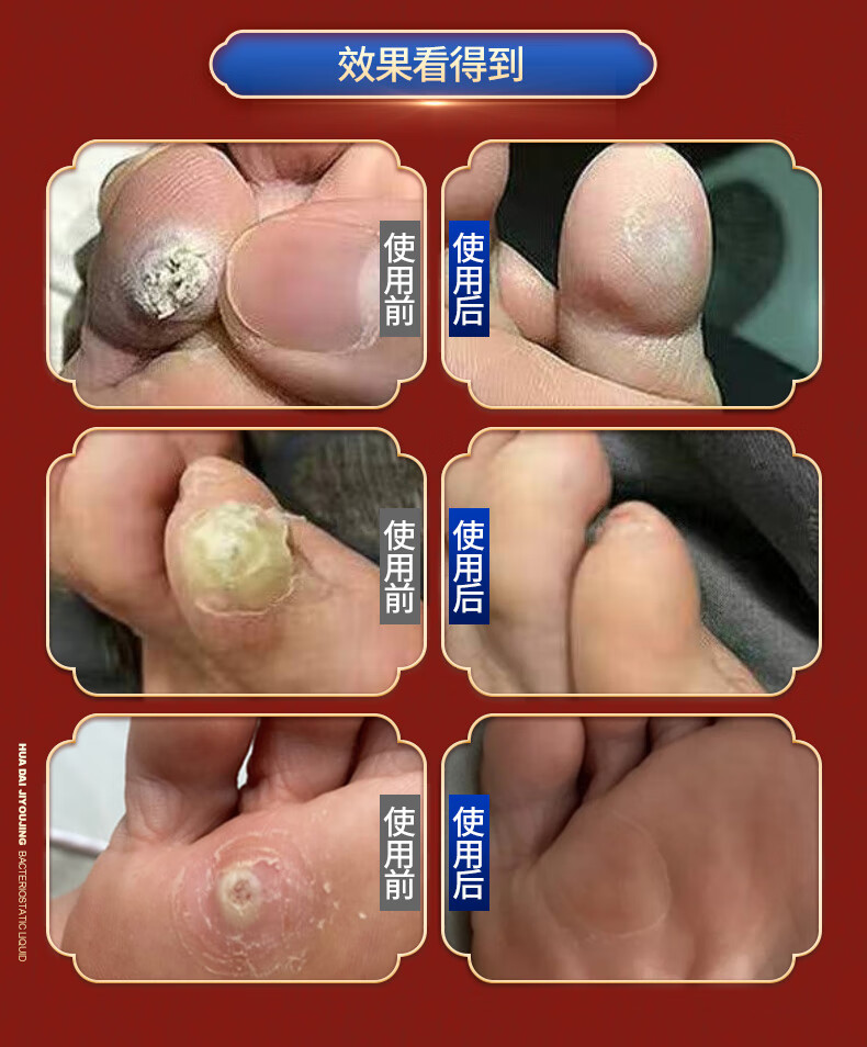 花带2号鸡尤净鸡眼膏老茧肉l刺脚垫硬皮趾l疣膏官方花带2号轻度体验装