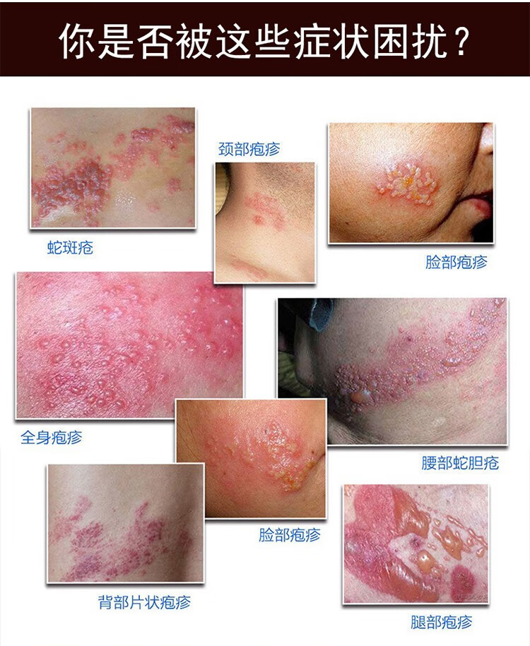 浅米草7号克蛇方带状疱痒后遗症神疼经痛疱痒蛇