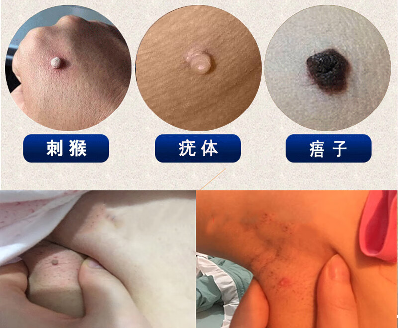 清赘去脖子上颈部腋下长小肉粒点猴子疙瘩的祛除肉瘤痣痦子