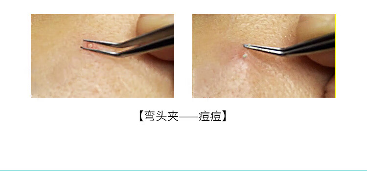 粉刺夹瑞士精密细胞夹拔黑头拔粉刺镊子直尖头美容镊子去黑头夹子送