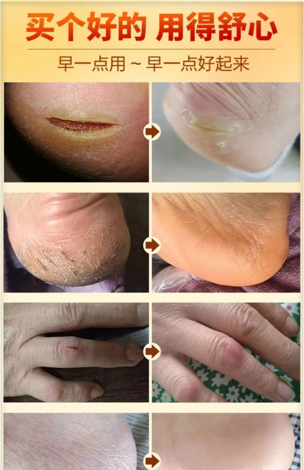 美士林护手霜皲裂膏脚后跟干裂脱皮防开裂口马油护手足修复霜滋润新