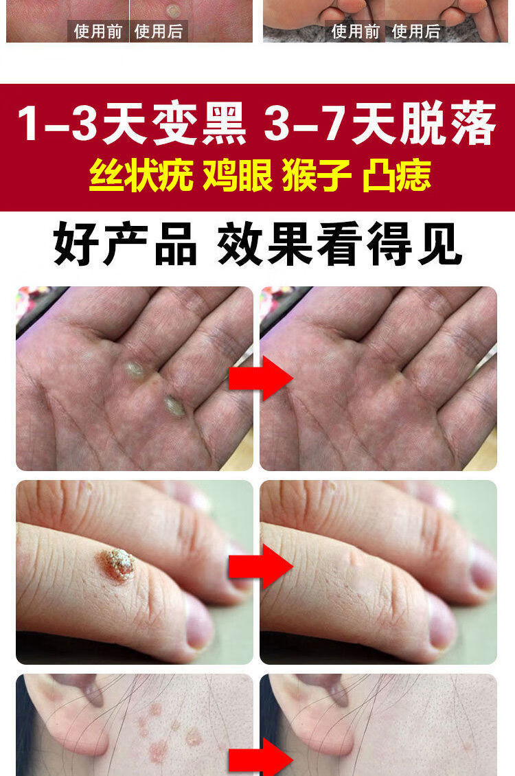 去脖子肉粒疙瘩l瘊l子神器去l丝l状l疣l嗖妤美鸦胆子祛l疣颈部刺瘊