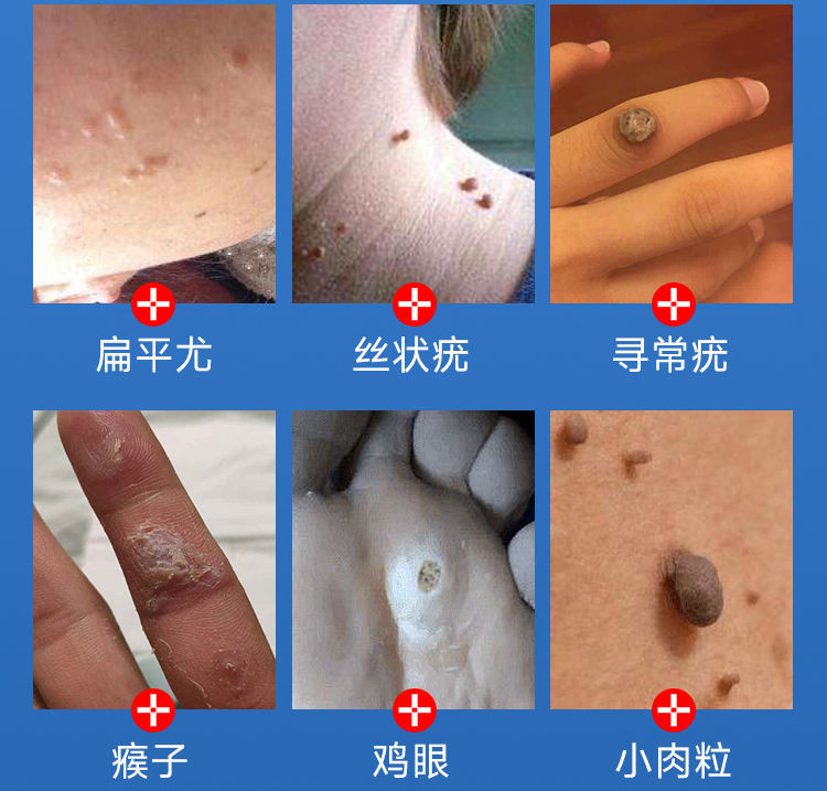 10046067018498商品名称:韩国进口原液去l肉痣肉粒肉l球跖l疣猴子老茧