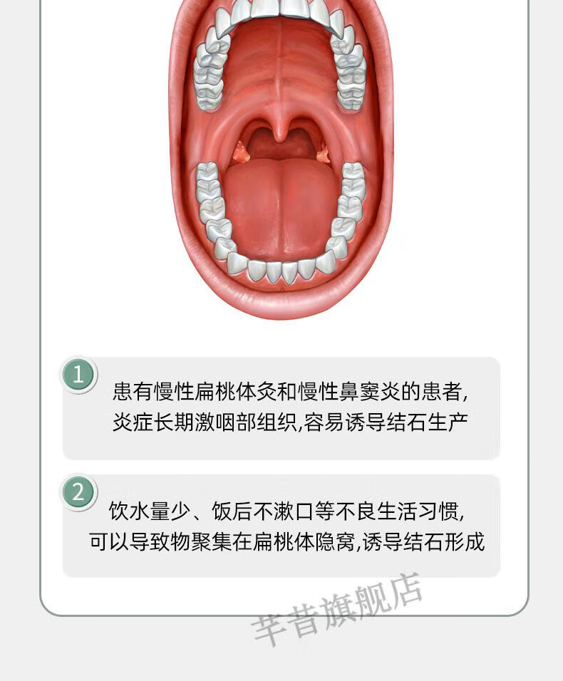 扁桃体结石去除工具 可视去除口腔吸取扁桃体喉结石工具隐窝扁导体
