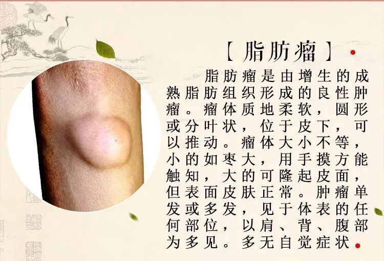 脂肪瘤消除贴单发性多发性脂肪瘤皮下脂肪瘤纤维瘤去ll脂肪ll粒神i器