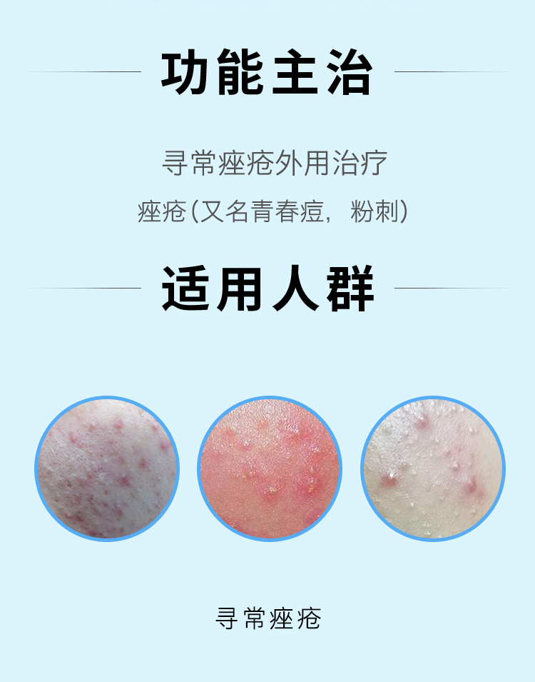 班赛 过氧苯甲酰凝胶 15g 痤疮闭口粉刺青春痘暗疮祛痘膏软膏药 3盒装