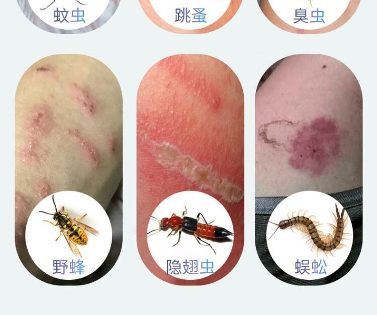 螨虫臭虫叮咬皮肤外用虫子咬跳蚤叮咬
