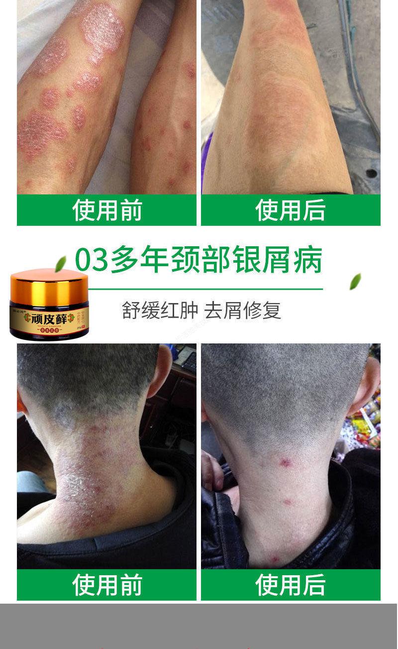 复方黄柏祛l癣搽剂治l疗牛l皮l癣银l屑l病瘙痒止l痒湿l疹去l根体l股l
