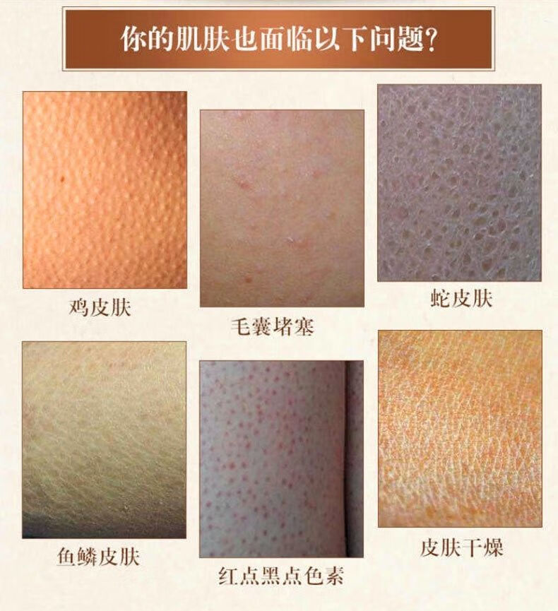 怎么治疗鸡皮肤和蛇皮肤(身上鸡皮肤蛇皮肤用什么效果好) 怎么治疗鸡皮肤和蛇皮肤(身上鸡皮肤蛇皮肤用什么效果好)