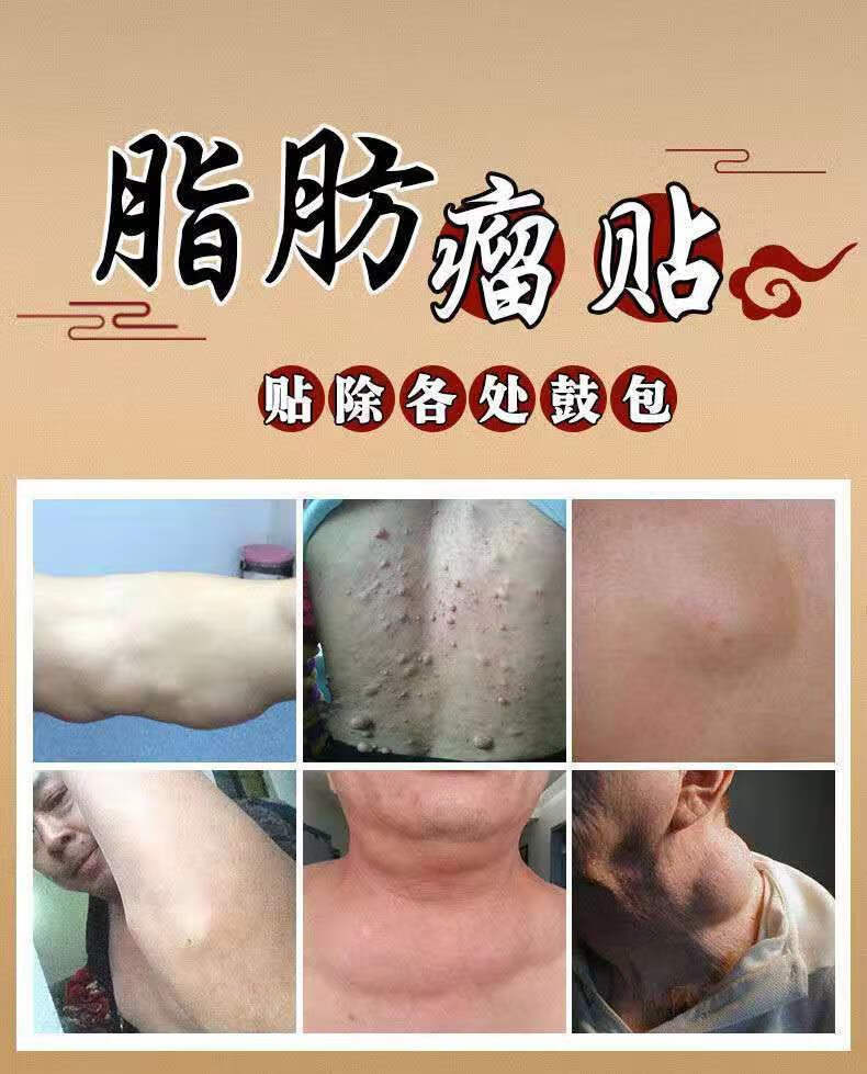 脂肪瘤贴脂肪瘤消贴皮下脂肪瘤肿块硬块多发性皮下囊肿脂肪瘤专用 买3