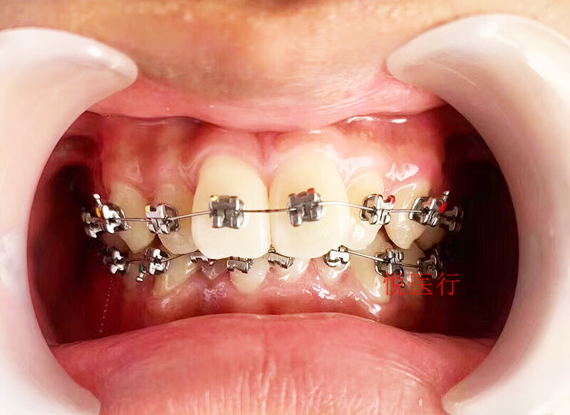 自锁托槽 牙科金属自锁正畸托槽5代6代金属自锁托槽有3证 3代plus
