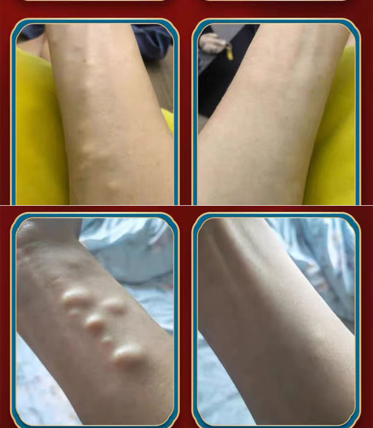 脂肪瘤去除膏 成人脂肪瘤脂肪瘤消贴皮下脂肪单发性和多发性肪皮下