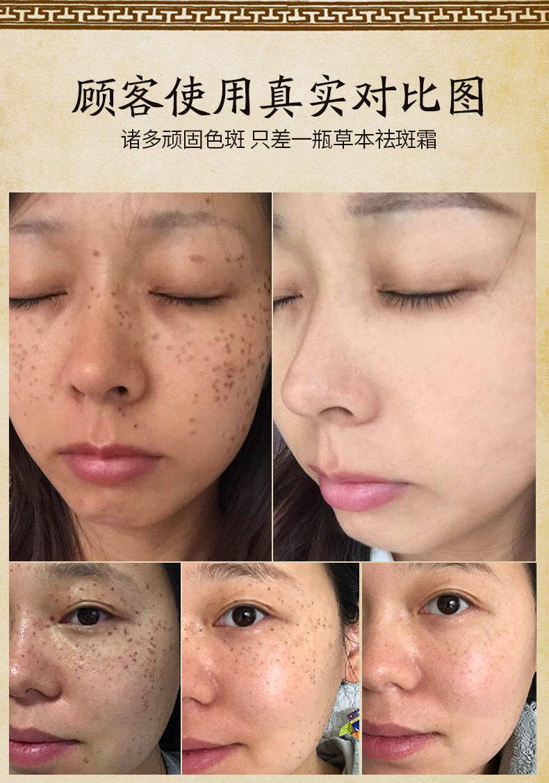 美百消斑霜草本中药去除黄褐斑点顽固雀斑老年斑黑色素 【打折捡漏】