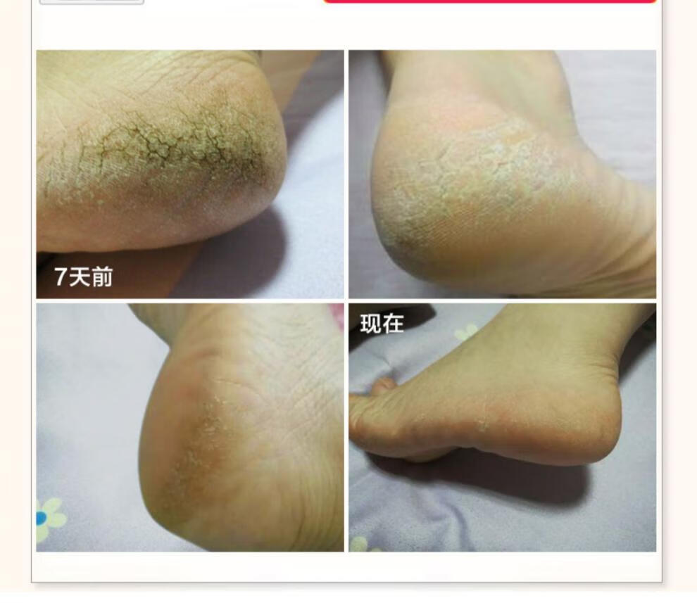 安德烈少校手足皲裂膏脚后跟干裂脱皮足裂霜防裂修复开裂口子 50g2fml