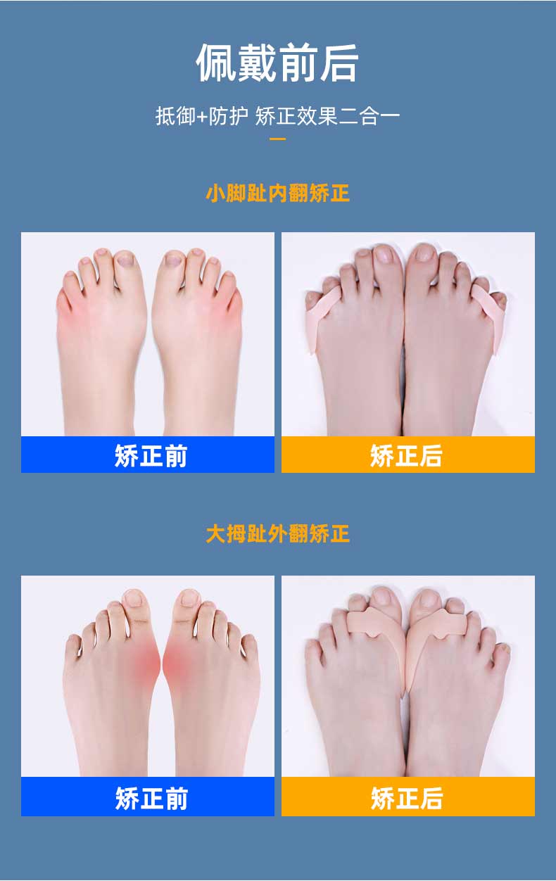 小脚趾矫正器防磨套小拇指防痛老茧外翻保护康复套五指变形内翻分趾器