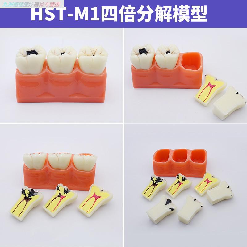 牙科教学模型口腔全口牙齿病理修复体牙模型标准种植模具医患沟通牙周