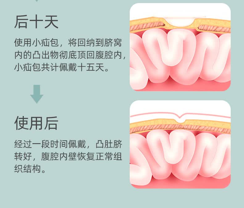 婴儿肚脐绑带 新生婴儿凸肚脐护脐带幼儿护理带宝宝压肚脐睡觉鼓突出