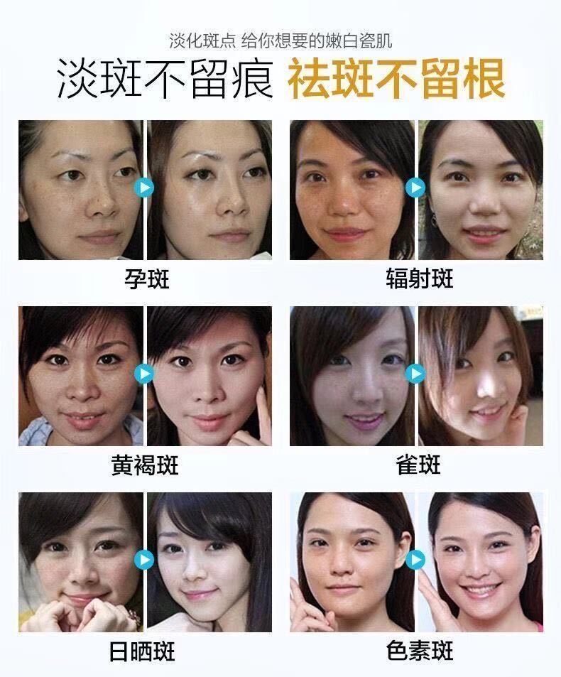 美白祛斑霜去斑点雀斑黄褐斑老人斑美白草本中药祛斑产品一盒巴黎元素