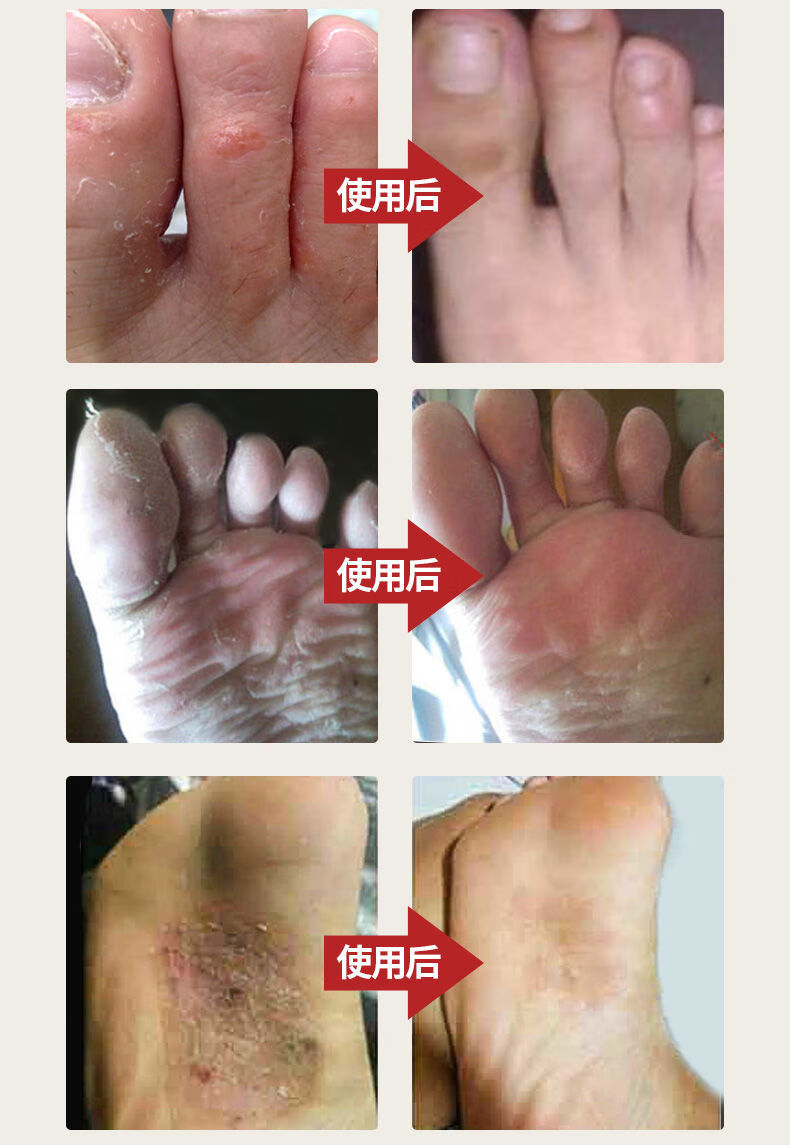 狼毒喷剂软脚.痒脱皮去除.脚臭.脚汗丫膏套装克.
