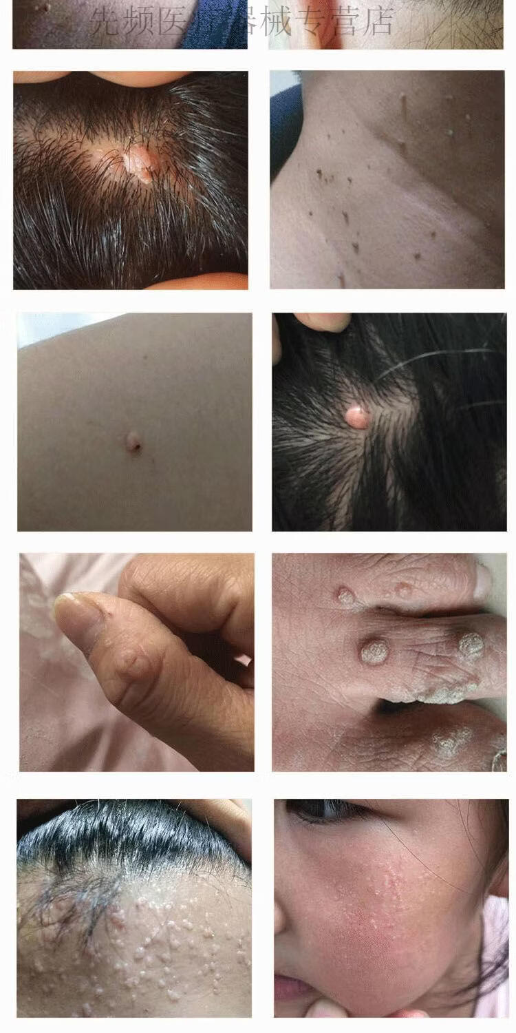 6015jd健康6015去脖子上小肉扁平疣颈部去丝状疣脖子腋下颈部