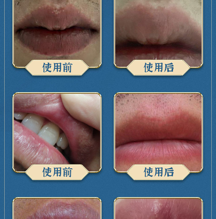 皮脂腺异位症嘴唇疱l疹起泡嘴唇增生嘴唇皮脂腺异位白点干裂专用膏 买