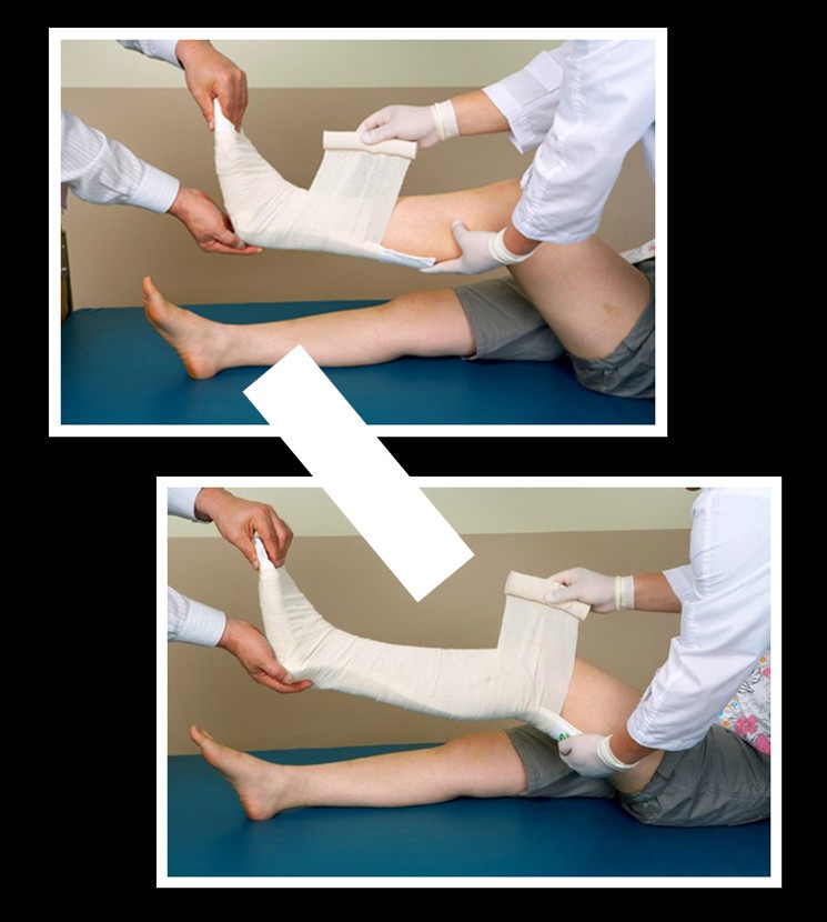 仁和同款医高分子夹板石膏骨折固定夹板急救石膏绷带医用护具脚踝腿部