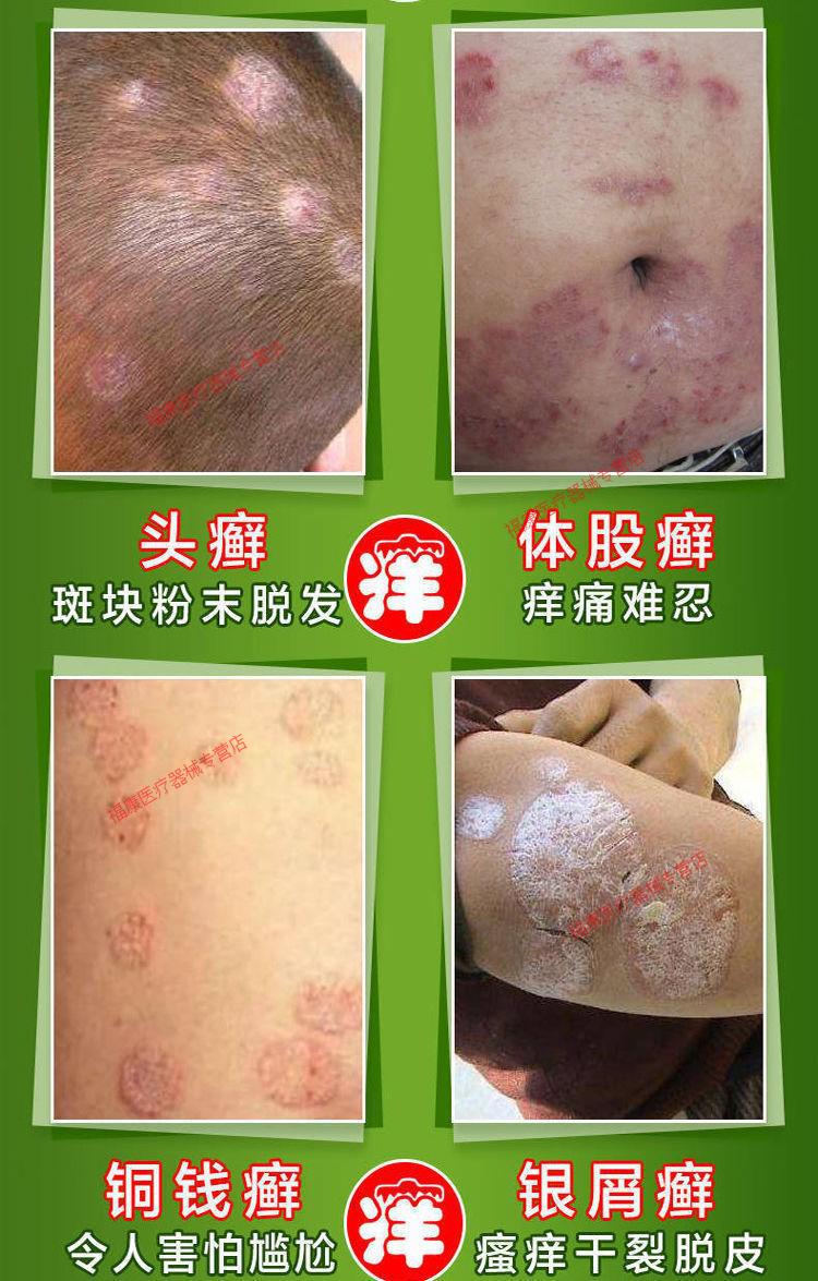 苗家老偏方皮癣牛专用皮肤癣痒灵瘙痒皮炎疹湿癣菌克星癣手足10支祛除