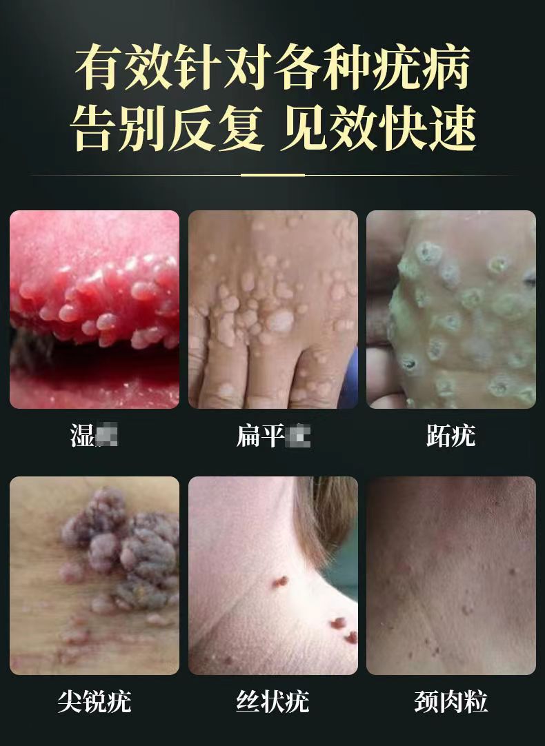 去尖锐湿疣hpv面部粒刺猴脖子氟尿嘧啶搭软膏两盒疗程装