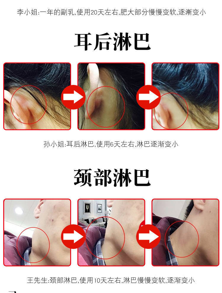 专治副乳副乳消除神器腋下消副乳贴淋巴散结结核肿大炎消贴淋巴消除侧