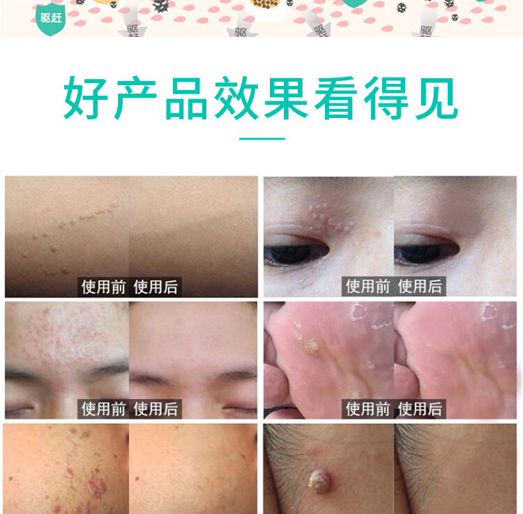 柯瑞森一号平疣专用日本灵去除寻疣丝状净神器二盒装