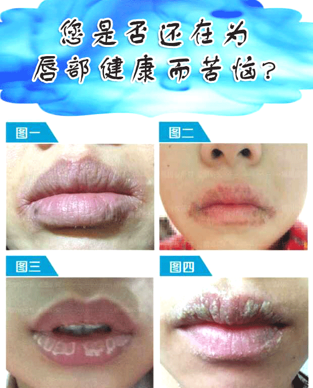 唇雨2号嘴唇干裂脱皮起皮结厚皮结痂修复防干裂脱皮起泡痒烂嘴角炎唇