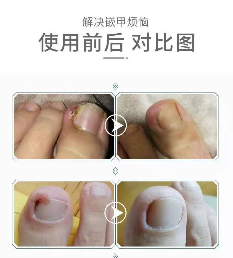 甲沟炎消肿嵌甲甲沟红肿疼痛器软化脱甲治疗膏 单盒装【图片 价格
