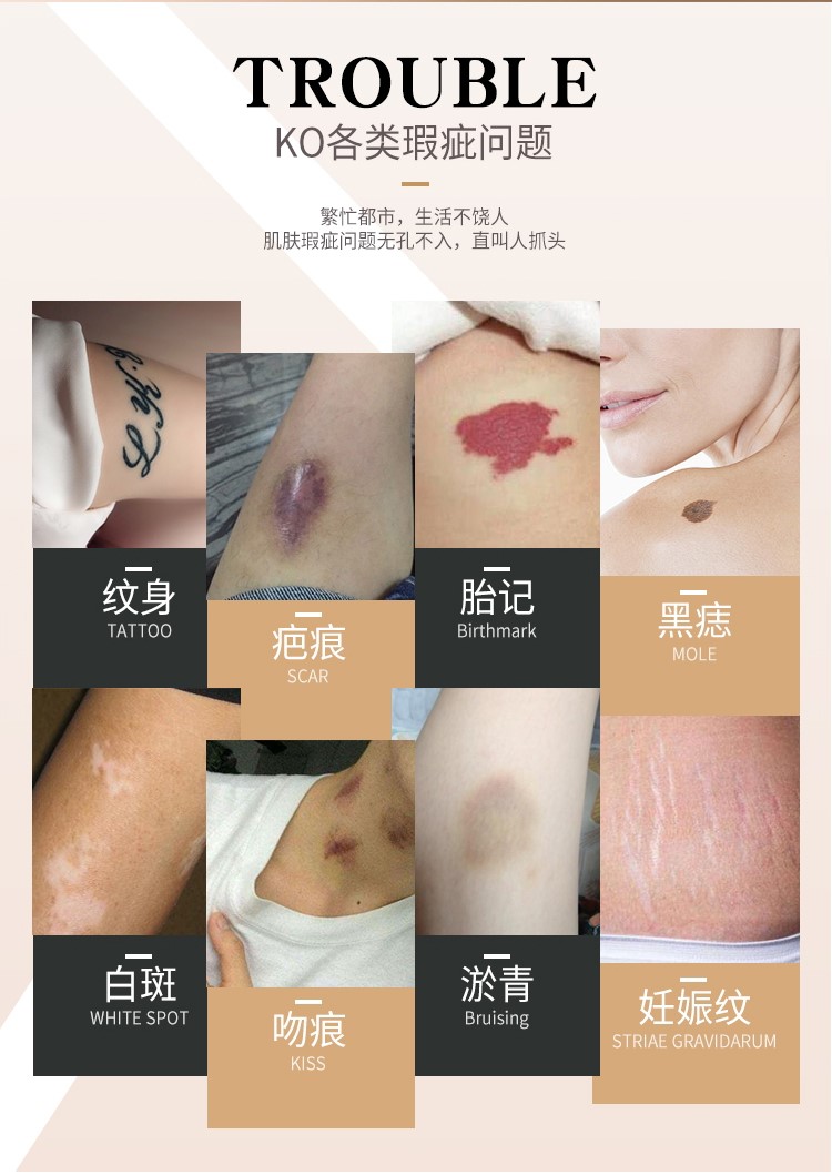 胎记纹身腿部鸡皮皮肤图片(腿上有胎记纹什么纹身比较好看) 胎记纹身腿部鸡皮皮肤图片(腿上有胎记纹什么纹身比较好看)