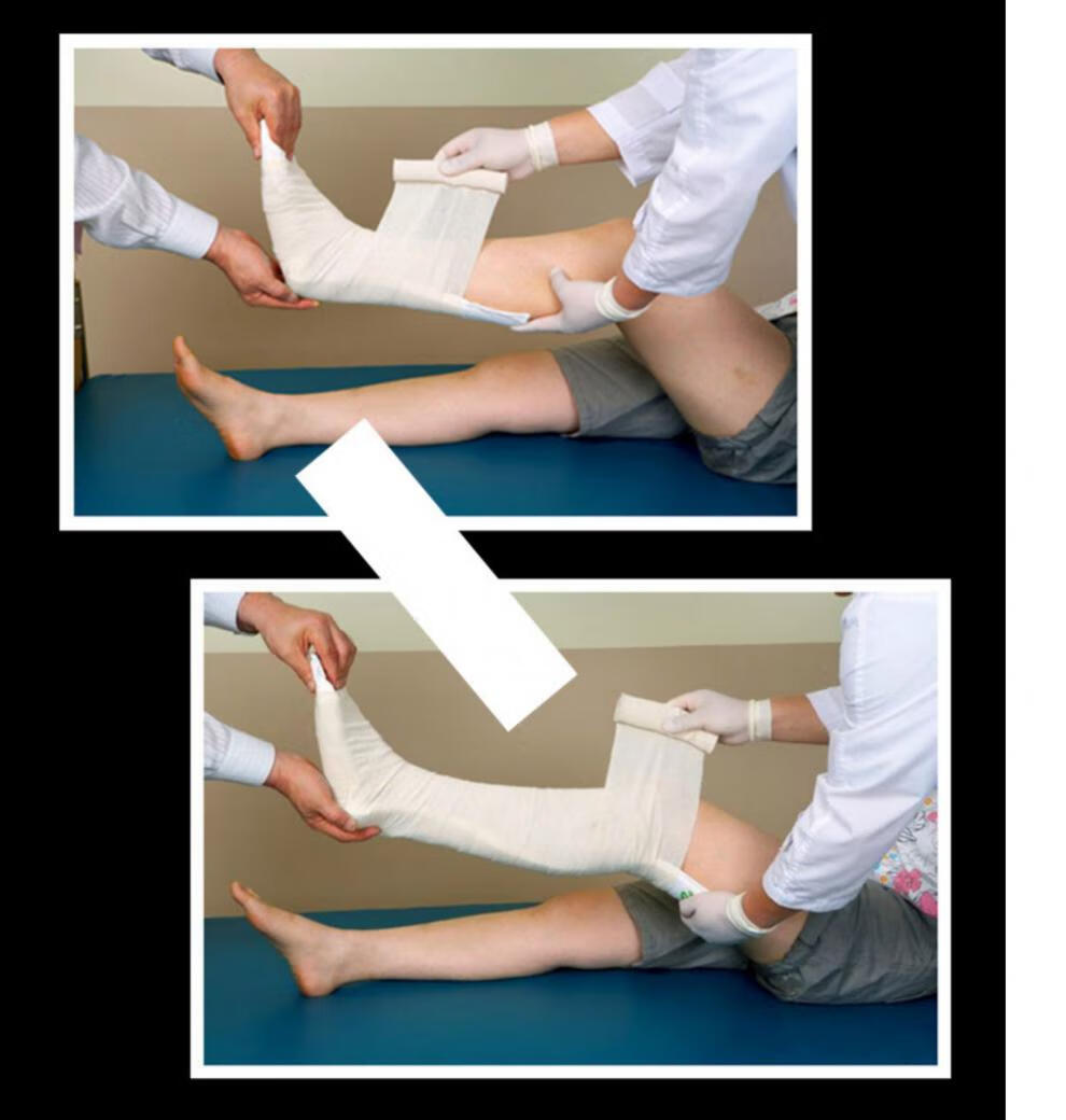 高分子固定夹板 医高分子夹板石膏固定夹板急救石膏绷带护具脚踝腿部