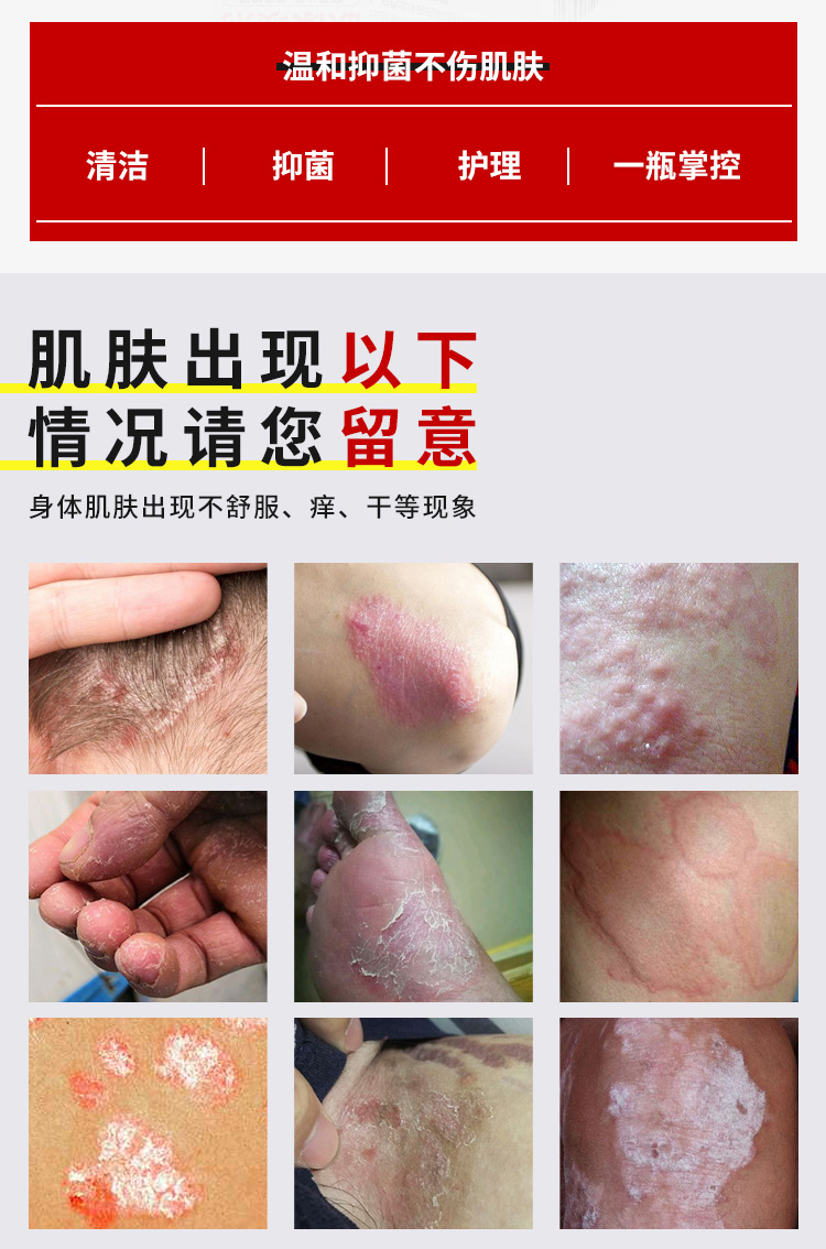 吴郎中肤康喷剂55ml男女湿痒干痒xian藓止痒手足xian藓水泡【图片